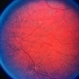 Choroideremia Carrier With Periperal Pigment Changes Choroideremia Carrier With Periperal Pigment Changes