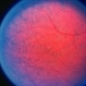 Choroideremia Carrier With Periperal Pigment Changes Choroideremia Carrier With Periperal Pigment Changes