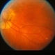Peripapillary Atrophy Peripapillary Atrophy