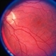 Choroideremia Carrier With Periperal Pigment Changes Choroideremia Carrier With Periperal Pigment Changes