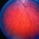 Choroideremia Carrier With Periperal Pigment Changes Choroideremia Carrier With Periperal Pigment Changes