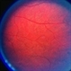 Choroideremia Carrier With Periperal Pigment Changes Choroideremia Carrier With Periperal Pigment Changes