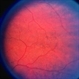 Choroideremia Carrier With Periperal Pigment Changes