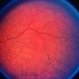 Choroideremia Carrier With Periperal Pigment Changes Choroideremia Carrier With Periperal Pigment Changes