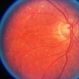 Choroideremia With Periperal Pigment Changes, Drusenoid Flecks, Patchy Atrophy