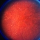 Choroideremia With Periperal Pigment Changes, Drusenoid Flecks, Patchy Atrophy Choroideremia With Periperal Pigment Changes, Drusenoid Flecks, Patchy Atrophy