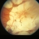 Congenital Monocular Choroidal Atrophy Congenital Monocular Choroidal Atrophy