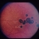 Acute Toxoplasmosis