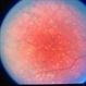 Choroideremia With Periperal Pigment Changes, Drusenoid Flecks, Patchy Atrophy Choroideremia With Periperal Pigment Changes, Drusenoid Flecks, Patchy Atrophy