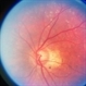 Choroideremia With Periperal Pigment Changes, Drusenoid Flecks, Patchy Atrophy Choroideremia With Periperal Pigment Changes, Drusenoid Flecks, Patchy Atrophy