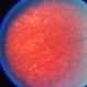 Choroideremia With Periperal Pigment Changes, Drusenoid Flecks, Patchy Atrophy Choroideremia With Periperal Pigment Changes, Drusenoid Flecks, Patchy Atrophy