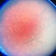 Choroideremia With Periperal Pigment Changes, Drusenoid Flecks, Patchy Atrophy Choroideremia With Periperal Pigment Changes, Drusenoid Flecks, Patchy Atrophy