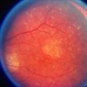 Choroideremia With Periperal Pigment Changes, Drusenoid Flecks, Patchy Atrophy Choroideremia With Periperal Pigment Changes, Drusenoid Flecks, Patchy Atrophy