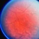 Choroideremia With Periperal Pigment Changes, Drusenoid Flecks, Patchy Atrophy Choroideremia With Periperal Pigment Changes, Drusenoid Flecks, Patchy Atrophy