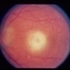 Acute Toxoplasmosis