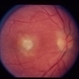 Acute Toxoplasmosis