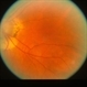Peripapillary Atrophy Peripapillary Atrophy