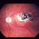 Toxoplasmosis