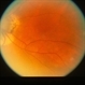 Peripapillary Atrophy Peripapillary Atrophy