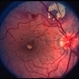 Leukemia Leukemia