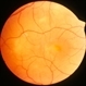 Multiple Vitelliforn Retinal 3