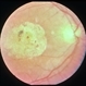 Macular Staphyloma