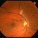 Hypertensive Retinopathy Hypertensive Retinopathy
