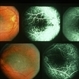 Inflammation Inflammation