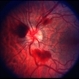 Leukemia Leukemia