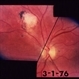 Acute Toxoplasmosis