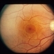 Toxoplasmosis