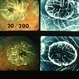 Macular Atrophy With FA Macular Atrophy With FA