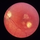 Congenital Toxoplasmosis