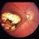 Congenital Toxoplasmosis