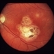 Congenital Toxoplasmosis