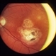 Congenital Toxoplasmosis