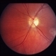 Congenital Toxoplasmosis