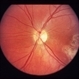 Congenital Toxoplasmosis