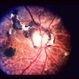 Ophthalmomyiasis