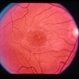 Macular Dystrophy With Flecks Macular Dystrophy With Flecks
