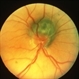 Probable Melanocytoma (Possible Melanoma) Probable Melanocytoma (Possible Melanoma)