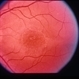 Macular Dystrophy With Flecks Macular Dystrophy With Flecks
