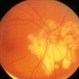Posterior Pole Chorioretinal Atrophy With Staphyloma