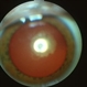 Posterior Subcapsular Cataract Posterior Subcapsular Cataract