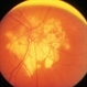 Posterior Pole Chorioretinal Atrophy With Staphyloma