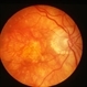 Central Areolar Choroidal Sclerosis