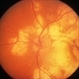 Posterior Pole Chorioretinal Atrophy With Staphyloma