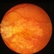 Central Areolar Choroidal Sclerosis