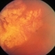 Posterior Pole Chorioretinal Atrophy With Staphyloma