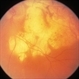Posterior Pole Chorioretinal Atrophy With Staphyloma